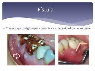  Trayecto patológico que comunica a una cavidad con el exterior
Fístula
 