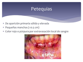  De aparición primaria sólida y elevada
 Pequeñas manchas (<0.5 cm)
 Color rojo o púrpura por extravasación local de sangre
Petequias
 