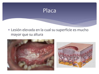  Lesión elevada en la cual su superficie es mucho
mayor que su altura
Placa
 