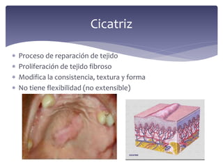  Proceso de reparación de tejido
 Proliferación de tejido fibroso
 Modifica la consistencia, textura y forma
 No tiene flexibilidad (no extensible)
Cicatriz
 