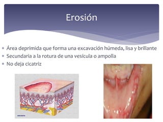  Área deprimida que forma una excavación húmeda, lisa y brillante
 Secundaria a la rotura de una vesícula o ampolla
 No deja cicatriz
Erosión
 