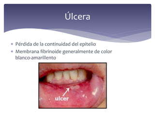  Pérdida de la continuidad del epitelio
 Membrana fibrinoide generalmente de color
blanco-amarillento
Úlcera
 