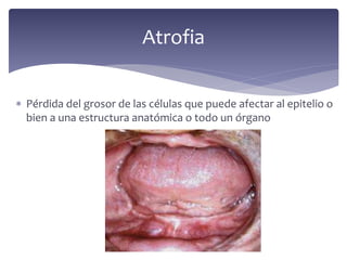  Pérdida del grosor de las células que puede afectar al epitelio o
bien a una estructura anatómica o todo un órgano
Atrofia
 