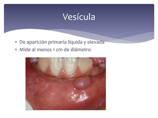  De aparición primaria líquida y elevada
 Mide al menos 1 cm de diámetro
Vesícula
 