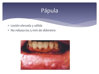  Lesión elevada y sólida
 No rebasa los 5 mm de diámetro
Pápula
 