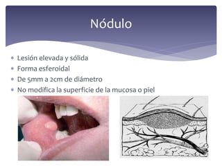  Lesión elevada y sólida
 Forma esferoidal
 De 5mm a 2cm de diámetro
 No modifica la superficie de la mucosa o piel
Nódulo
 
