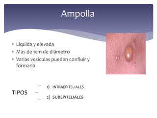  Líquida y elevada
 Mas de 1cm de diámetro
 Varias vesículas pueden confluir y
formarla
Ampolla
TIPOS
1) INTRAEPITELIALES
2) SUBEPITELIALES
 
