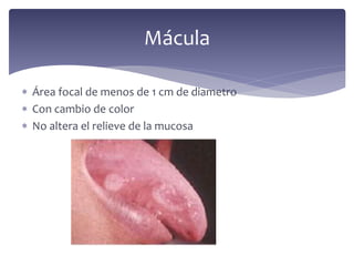  Área focal de menos de 1 cm de diametro
 Con cambio de color
 No altera el relieve de la mucosa
Mácula
 