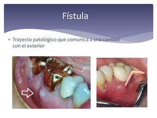  Trayecto patológico que comunica a una cavidad
con el exterior
Fístula
 