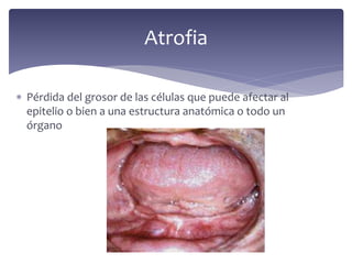  Pérdida del grosor de las células que puede afectar al
epitelio o bien a una estructura anatómica o todo un
órgano
Atrofia
 
