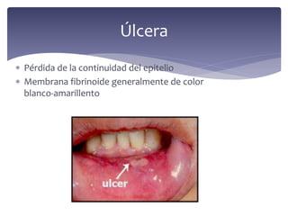  Pérdida de la continuidad del epitelio
 Membrana fibrinoide generalmente de color
blanco-amarillento
Úlcera
 