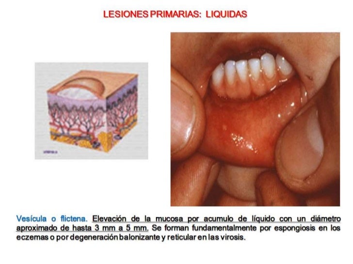 LESIONES ELEMENTALES DE LA MUCOSA ORAL