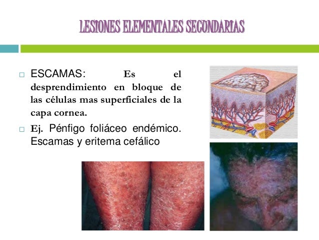 Lesiones Secundarias De La Piel