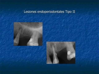 Lesiones endoperiodontales Tipo II 
