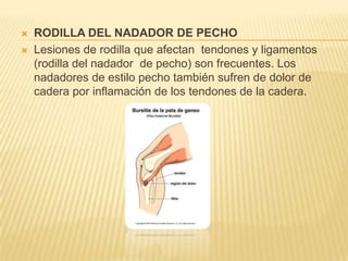 


RODILLA DEL NADADOR DE PECHO
Lesiones de rodilla que afectan tendones y ligamentos
(rodilla del nadador de pecho) son frecuentes. Los
nadadores de estilo pecho también sufren de dolor de
cadera por inflamación de los tendones de la cadera.

 