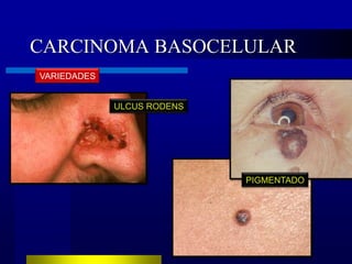 CARCINOMA BASOCELULAR
VARIEDADES


             ULCUS RODENS




                            PIGMENTADO
 