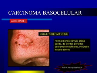 CARCINOMA BASOCELULAR
VARIEDADES




             ESCLERODERMIFORME

                      Forma menos comun, placa
                      palida, de bordes perlados
                      pobremente definidos, indurado
                      invade dermis.




                            Mas de placa que de nodulo
 