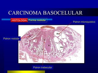 CARCINOMA BASOCELULAR
       HISTOLOGIA Forma nodular
                                          Patron microquistico




Patron nodular




                      Patron trabecular
 
