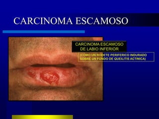 CARCINOMA ESCAMOSO

         CARCINOMA ESCAMOSO
           DE LABIO INFERIOR
          (COMO UN RODETE PERIFERICO INDURADO
          SOBRE UN FONDO DE QUEILITIS ACTINICA)
 