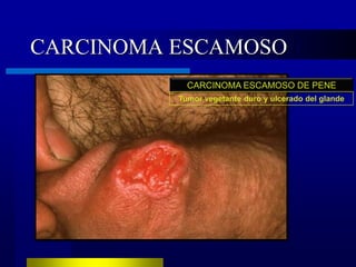 CARCINOMA ESCAMOSO
            CARCINOMA ESCAMOSO DE PENE
          Tumor vegetante duro y ulcerado del glande
 