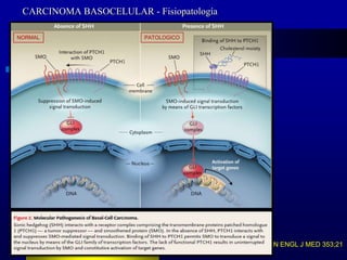 CARCINOMA BASOCELULAR - Fisiopatología

NORMAL                  PATOLOGICO




                                          N ENGL J MED 353;21
 