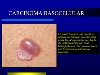 CARCINOMA BASOCELULAR


             La lesión típica es una pápula o
             nódulo, no doloroso de coloración
             perla, tamaño pequeño, recubierta
             de piel translúcida con finas
             telangiectasias Su centro aparece
             con frecuencia erosionado o
             ulcerado.
 