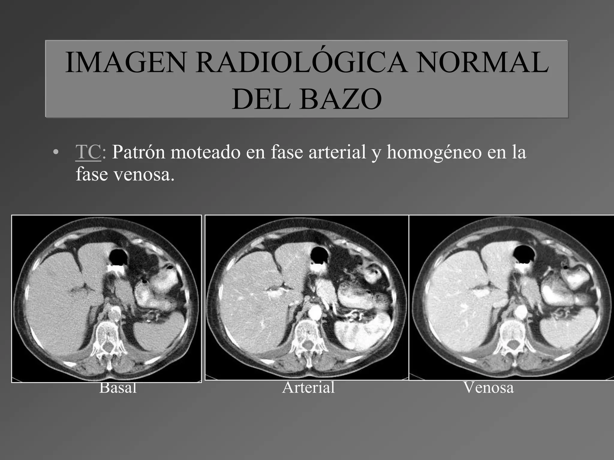 Lesiones focales en el bazo | PPTX