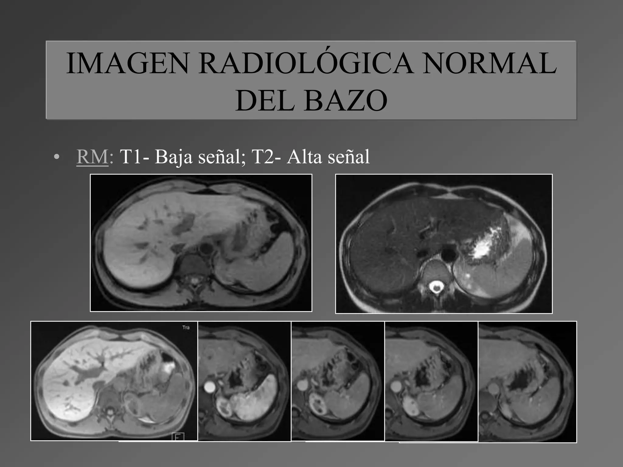 Lesiones focales en el bazo | PPTX