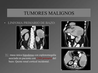 Lesiones focales en el bazo | PPTX