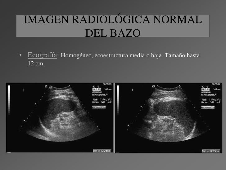 Dimensiones Del Bazo Por Ecografia Lesiones focales en el bazo
