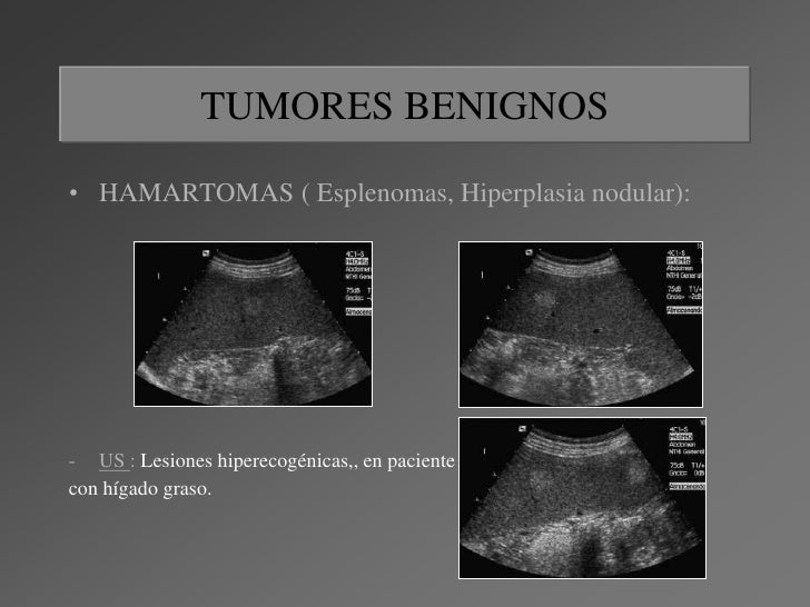 Dimensiones Del Bazo Por Ecografia Lesiones focales en el bazo