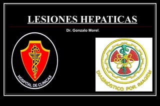 LESIONES HEPATICAS
Dr. Gonzalo Morel.
 