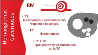 Hemangiomas
Cavernosos
• T1:
hipointensos o isointensos con
respecto a la sangre.
RM
• T2:
Hiperintensos.
• T1 + C:
Igual patrón de captación que
en la TC.
 