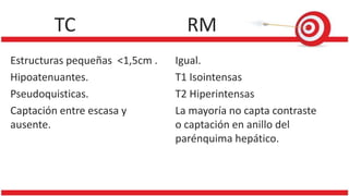 TC RM
Estructuras pequeñas <1,5cm .
Hipoatenuantes.
Pseudoquisticas.
Captación entre escasa y
ausente.
Igual.
T1 Isointensas
T2 Hiperintensas
La mayoría no capta contraste
o captación en anillo del
parénquima hepático.
 
