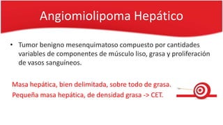 Angiomiolipoma Hepático
• Tumor benigno mesenquimatoso compuesto por cantidades
variables de componentes de músculo liso, grasa y proliferación
de vasos sanguíneos.
Masa hepática, bien delimitada, sobre todo de grasa.
Pequeña masa hepática, de densidad grasa -> CET.
 