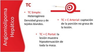 • TC Simple:
Heterogéneo
Densidad grasa y de
tejidos blandos.
Angiomiolipoma
Hepático
TC
• TC + C Arterial: captación
de la porción no grasa de
la lesión.
• TC + C Portal: la
lesión muestra
hipoatenuación de
toda la masa.
 