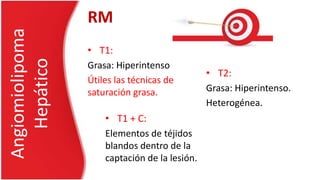 • T1:
Grasa: Hiperintenso
Útiles las técnicas de
saturación grasa.
Angiomiolipoma
Hepático
RM
• T2:
Grasa: Hiperintenso.
Heterogénea.
• T1 + C:
Elementos de téjidos
blandos dentro de la
captación de la lesión.
 