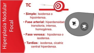 HiperplasiaNodular
Focal • Simple: Isodensa o
hipointensa.
• Fase arterial: hiperdensidad
transitoria, intensa,
homogénea.
TC
• Fase venosa: hipodensa o
isodensa.
• Tardías: isodensa, cicatriz
central hiperdensa.
 