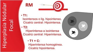 • T1:
Isointensos o lig. hipointenso.
Cicatriz central: Hipointensa.
RM
• T2:
Hiperintensa a isointensa
Cicatriz central: Hiperintensa.
• T1 + C:
Hiperintensa homogénea.
Cicatriz hipointensa.
HiperplasiaNódular
Focal
 