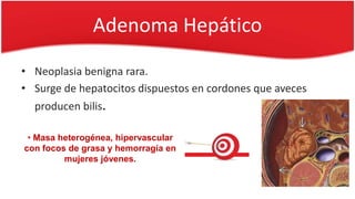 Adenoma Hepático
• Neoplasia benigna rara.
• Surge de hepatocitos dispuestos en cordones que aveces
producen bilis.
• Masa heterogénea, hipervascular
con focos de grasa y hemorragía en
mujeres jóvenes.
 