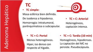 • TC simple:
Masa esférica bien definida.
De isodensa a hipodensa.
Hemorragia: intratumoral,
parénquimatosa o subcapsular.
AdenomaHepático TC
• TC + C: Portal
Menos heterogéneos.
Hiper, iso denso con
respecto al hígado.
• TC + C: Arterial
Heterogéneos,
captación intensa.
• TC + C: Tardia (10 min)
Homogéneos, hipodensos.
La captación del MC no
persiste. Pseudocápsula.
 