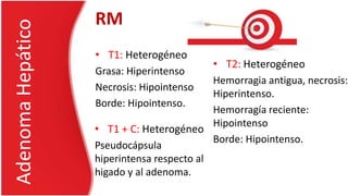 • T1: Heterogéneo
Grasa: Hiperintenso
Necrosis: Hipointenso
Borde: Hipointenso.
AdenomaHepático RM
• T2: Heterogéneo
Hemorragia antigua, necrosis:
Hiperintenso.
Hemorragía reciente:
Hipointenso
Borde: Hipointenso.
• T1 + C: Heterogéneo
Pseudocápsula
hiperintensa respecto al
higado y al adenoma.
 