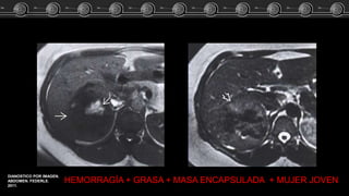 HEMORRAGÍA + GRASA + MASA ENCAPSULADA + MUJER JOVEN
DIANOSTICO POR IMAGEN.
ABDOMEN. FEDERLE.
2011.
 