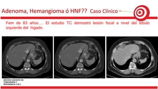 Adenoma, Hemangioma ó HNF?? Caso Clínico
Fem de 83 años…. El estudio TC demostró lesión focal a nivel del lóbulo
izquierdo del higado.
ARCHIVO DOCENTE DE
TOMOGRAFÍA Y
RESONANCIA C.M.C.
 