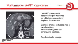 Malformacion A-V?? Caso Clínico
Las MAV pueden estar
ocasionadas por trastornos
hereditarios que ocasionan
displasia fibrovascular.
Grandes arterias tortuosas intra y
extrahepaticas.
Realce heterogéneo del
parénquima hepático.
Pueden simular masas.
DIANOSTICO POR IMAGEN.
ABDOMEN. FEDERLE.
2011.
 