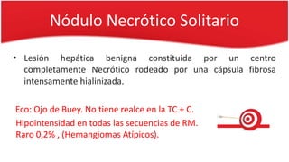 Nódulo Necrótico Solitario
• Lesión hepática benigna constituida por un centro
completamente Necrótico rodeado por una cápsula fibrosa
intensamente hialinizada.
Eco: Ojo de Buey. No tiene realce en la TC + C.
Hipointensidad en todas las secuencias de RM.
Raro 0,2% , (Hemangiomas Atípicos).
 