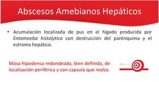 Abscesos Amebianos Hepáticos
• Acumulación localizada de pus en el hígado producida por
Entamoeba histolytica con destrucción del parénquima y el
estroma hepático.
Masa hipodensa redondeada, bien definida, de
localización periférica y con capsula que realza.
 