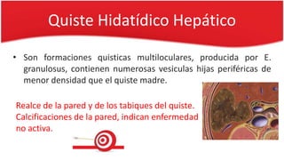 Quiste Hidatídico Hepático
• Son formaciones quisticas multiloculares, producida por E.
granulosus, contienen numerosas vesiculas hijas periféricas de
menor densidad que el quiste madre.
Realce de la pared y de los tabiques del quiste.
Calcificaciones de la pared, indican enfermedad
no activa.
 