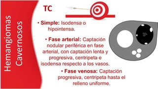 Hemangiomas
Cavernosos
• Fase arterial: Captación
nodular periférica en fase
arterial, con captación lenta y
progresiva, centripeta e
isodensa respecto a los vasos.
• Fase venosa: Captación
progresiva, centripeta hasta el
relleno uniforme.
TC
• Simple: Isodensa o
hipointensa.
 
