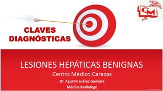 LESIONES HEPÁTICAS BENIGNAS
Centro Médico Caracas
Dr. Agustín Juárez Guevara
Médico Radiologo
CLAVES
DIAGNÓSTICAS
 